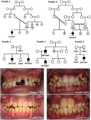 A Fourth KLK4 Mutation Is Associated with Enamel Hypomineralisation and Structural Abnormalities